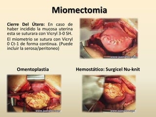 MiomectomiaCierre Del Útero: En caso de haber incidido la mucosa uterina esta se suturara con Vicryl 3-0 SH.El miometrio se sutura con Vicryl 0 Ct-1 de forma continua. (Puede incluir la serosa/peritoneo)Hemostático: SurgicelNu-knitOmentoplastia