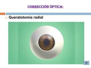 CORRECCIÓN ÓPTICA:

   Queratotomía radial
 