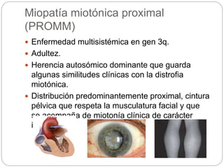 Miopatía miotónica proximal
(PROMM)
 Enfermedad multisistémica en gen 3q.
 Adultez.
 Herencia autosómico dominante que guarda
algunas similitudes clínicas con la distrofia
miotónica.
 Distribución predominantemente proximal, cintura
pélvica que respeta la musculatura facial y que
se acompaña de miotonía clínica de carácter
inconstante.
 