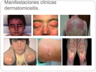 Manifestaciones clínicas
dermatomiositis.
 