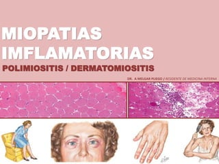 MIOPATIAS
IMFLAMATORIAS
POLIMIOSITIS / DERMATOMIOSITIS
DR. A MELGAR PLIEGO / RESIDENTE DE MEDICINA INTERNA
 