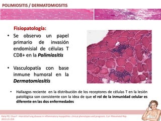 POLIMIOSITIS / DERMATOMIOSITIS
• Se observo un papel
primario de invasión
endomisial de células T
CD8+ en la Polimiositis
• Vasculopatía con base
inmune humoral en la
Dermatomiositis
Fisiopatología:
• Hallazgos reciente en la distribución de los receptores de células T en la lesión
patológica son consistente con la idea de que el rol de la inmunidad celular es
diferente en las dos enfermedades
Kiely PD, Chua F. Interstitial lung disease in inflammatory myopathies: clinical phenotypes and prognosis. Curr Rheumatol Rep
2013;15:359.
 