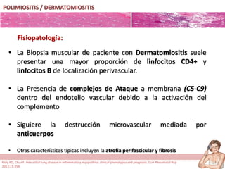 POLIMIOSITIS / DERMATOMIOSITIS
• La Biopsia muscular de paciente con Dermatomiositis suele
presentar una mayor proporción de linfocitos CD4+ y
linfocitos B de localización perivascular.
• La Presencia de complejos de Ataque a membrana (C5-C9)
dentro del endotelio vascular debido a la activación del
complemento
• Siguiere la destrucción microvascular mediada por
anticuerpos
• Otras características típicas incluyen la atrofia perifascicular y fibrosis
Fisiopatología:
Kiely PD, Chua F. Interstitial lung disease in inflammatory myopathies: clinical phenotypes and prognosis. Curr Rheumatol Rep
2013;15:359.
 