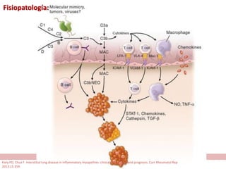 Fisiopatología:
Kiely PD, Chua F. Interstitial lung disease in inflammatory myopathies: clinical phenotypes and prognosis. Curr Rheumatol Rep
2013;15:359.
 
