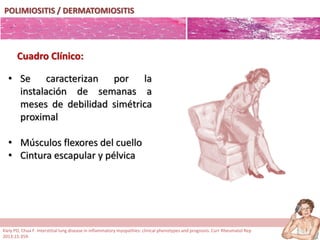 POLIMIOSITIS / DERMATOMIOSITIS
• Se caracterizan por la
instalación de semanas a
meses de debilidad simétrica
proximal
• Músculos flexores del cuello
• Cintura escapular y pélvica
Cuadro Clínico:
Kiely PD, Chua F. Interstitial lung disease in inflammatory myopathies: clinical phenotypes and prognosis. Curr Rheumatol Rep
2013;15:359.
 
