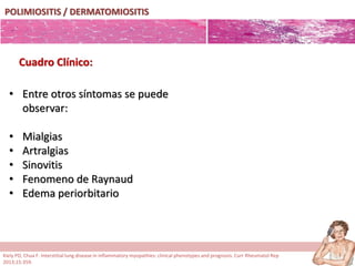 POLIMIOSITIS / DERMATOMIOSITIS
• Entre otros síntomas se puede
observar:
• Mialgias
• Artralgias
• Sinovitis
• Fenomeno de Raynaud
• Edema periorbitario
Cuadro Clínico:
Kiely PD, Chua F. Interstitial lung disease in inflammatory myopathies: clinical phenotypes and prognosis. Curr Rheumatol Rep
2013;15:359.
 