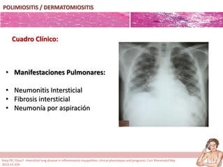 POLIMIOSITIS / DERMATOMIOSITIS
• Manifestaciones Pulmonares:
• Neumonitis Intersticial
• Fibrosis intersticial
• Neumonía por aspiración
Cuadro Clínico:
Kiely PD, Chua F. Interstitial lung disease in inflammatory myopathies: clinical phenotypes and prognosis. Curr Rheumatol Rep
2013;15:359.
 
