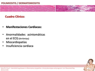POLIMIOSITIS / DERMATOMIOSITIS
• Manifestaciones Cardiacas:
• Anormalidades asintomáticas
en el ECG (Arritmias)
• Miocardiopatías
• Insuficiencia cardiaca
Cuadro Clínico:
Kiely PD, Chua F. Interstitial lung disease in inflammatory myopathies: clinical phenotypes and prognosis. Curr Rheumatol Rep
2013;15:359.
 