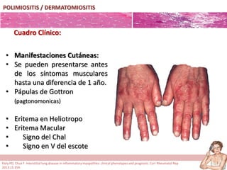 POLIMIOSITIS / DERMATOMIOSITIS
• Manifestaciones Cutáneas:
• Se pueden presentarse antes
de los síntomas musculares
hasta una diferencia de 1 año.
• Pápulas de Gottron
(pagtonomonicas)
• Eritema en Heliotropo
• Eritema Macular
• Signo del Chal
• Signo en V del escote
Cuadro Clínico:
Kiely PD, Chua F. Interstitial lung disease in inflammatory myopathies: clinical phenotypes and prognosis. Curr Rheumatol Rep
2013;15:359.
 