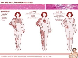 POLIMIOSITIS / DERMATOMIOSITIS
Antisintetasa
*Neumopatía
intersticial
*Artritis
*Manos de
Mecánico
*Fiebre
Dalakas MC. Review: an update on inflammatory and autoimmune myopathies. 2011; 37:226-42
 