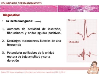 POLIMIOSITIS / DERMATOMIOSITIS
• La Electromiografía: (Triada)
1. Aumento de actividad de inserción,
fibrilaciones y ondas agudas positivas.
2. Descargas espontaneas bizarras de alta
frecuencia
3. Potenciales polifásicos de la unidad
motora de baja amplitud y corta
duración
Diagnostico:
Dalakas MC. Review: an update on inflammatory and autoimmune myopathies. 2011; 37:226-42
 
