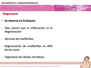 POLIMIOSITIS / DERMATOMIOSITIS
Diagnostico:
• Se observa en la biopsia:
- Mas común que la inflamación es la
degeneración
- Necrosis de miofibrillas
- Regeneración de miofibrillas en 90%
de los casos
- Fagocitosis de células necróticas
Dalakas MC. Review: an update on inflammatory and autoimmune myopathies. 2011; 37:226-42
 