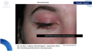 Estudiar siempre
Vol. 26. Núm. 7.páginas 330-340 (Agosto - Septiembre 2011)-
DOI: 10.1016/j.piel.2011.02.012- Dermatomiositis
EXANTEMA heliotropo en dermatomiositis
Dermatomiositis
 