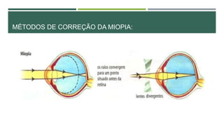 MÉTODOS DE CORREÇÃO DA MIOPIA:
 