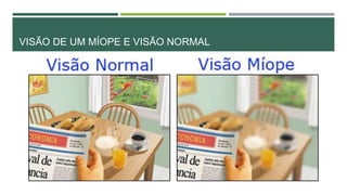 VISÃO DE UM MÍOPE E VISÃO NORMAL
 