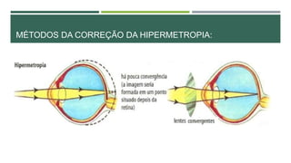MÉTODOS DA CORREÇÃO DA HIPERMETROPIA:
 