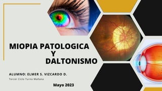MIOPIA PATOLOGICA
Y
DALTONISMO
ALUMNO: ELMER S. VIZCARDO D.
Mayo 2023
Tercer Ciclo Turno Mañana
 