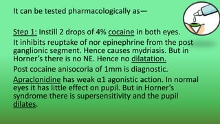 It can be tested pharmacologically as—
Step 1: Instill 2 drops of 4% cocaine in both eyes.
It inhibits reuptake of nor epinephrine from the post
ganglionic segment. Hence causes mydriasis. But in
Horner’s there is no NE. Hence no dilatation.
Post cocaine anisocoria of 1mm is diagnostic.
Apraclonidine has weak α1 agonistic action. In normal
eyes it has little effect on pupil. But in Horner’s
syndrome there is supersensitivity and the pupil
dilates.
 