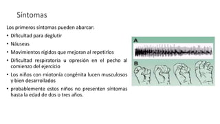 Miotonía congénita