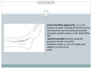 INCISION
anteromedial approach, a 2–3 cm
incision is made starting at the level of the
tibial plafond and extending proximally
along the medial surface of the distal tibia.
OR
posteromedial incision along the
posterior border of medial
malleolus about 4–5 cm in length and
slightly curved can be
used
 