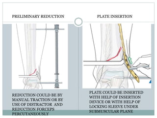 PRELIMINARY REDUCTION
REDUCTION COULD BE BY
MANUAL TRACTION OR BY
USE OF DISTRACTOR AND
REDUCTION FORCEPS
PERCUTANEOUSLY
PLATE INSERTION
PLATE COULD BE INSERTED
WITH HELP OF INSERTION
DEVICE OR WITH HELP OF
LOCKING SLEEVE UNDER
SUBMUSCULAR PLANE
 