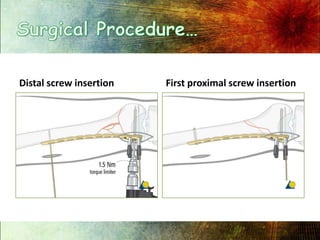 Surgical Procedure…,[object Object],Distal screw insertion,[object Object],First proximal screw insertion,[object Object]