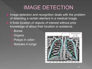 Image detection and recognition deals with the problem
of detecting a certain element in a medical image.
 It finds location of objects of interest without prior
knowledge of about their location or existence.
 Bones
 Organs
 Polyps in colon
 Nodules in lungs
19
 