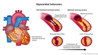 MI PPTS.POWERPOINT PRESENTATION ON MYOCARDIAL INFARCTIONS | PPTX