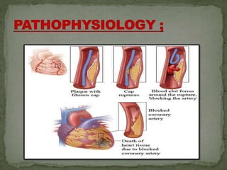 MYOCARDIAL INFARCTION [presentation ] | PPTX