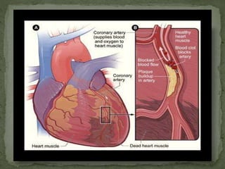 MYOCARDIAL INFARCTION [presentation ] | PPTX