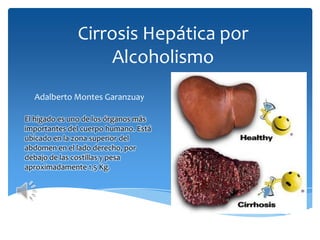 Cirrosis Hepática por
Alcoholismo
Adalberto Montes Garanzuay
El hígado es uno de los órganos más
importantes del cuerpo humano. Está
ubicado en la zona superior del
abdomen en el lado derecho, por
debajo de las costillas y pesa
aproximadamente 1.5 Kg.

 