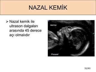 31/43
NAZAL KEMİK
 Nazal kemik ile
ultrason dalgaları
arasında 45 derece
açı olmalıdır
 