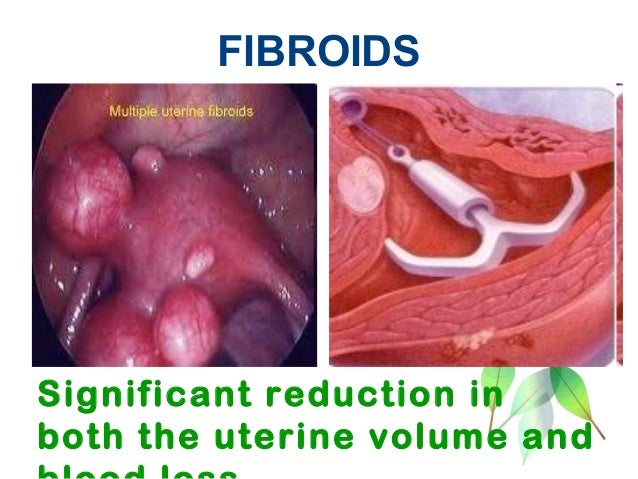 LNG-IUS: heavy menstrual bleeding What is new??? Dr. Jyoti Agarwal /… LNG-IUS: heavy menstrual bleeding What is new??? Dr. Jyoti Agarwal /…