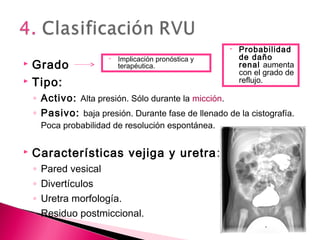  Grado
 Tipo:
◦ Activo: Alta presión. Sólo durante la micción.
◦ Pasivo: baja presión. Durante fase de llenado de la cistografía.
Poca probabilidad de resolución espontánea.
 Características vejiga y uretra:
◦ Pared vesical
◦ Divertículos
◦ Uretra morfología.
◦ Residuo postmiccional.
• Implicación pronóstica y
terapéutica.
• Probabilidad
de daño
renal aumenta
con el grado de
reflujo.
 