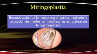 Ugo Fisch. Timpanoplastia, Mastoidectomía y Cirugia del Estribo. Editorial Thieme. 1994
Miringoplastia
Reconstrucción de la membrana timpánica mediante la
colocación de injertos, sin modificar las estructuras de
la caja timpánica
 