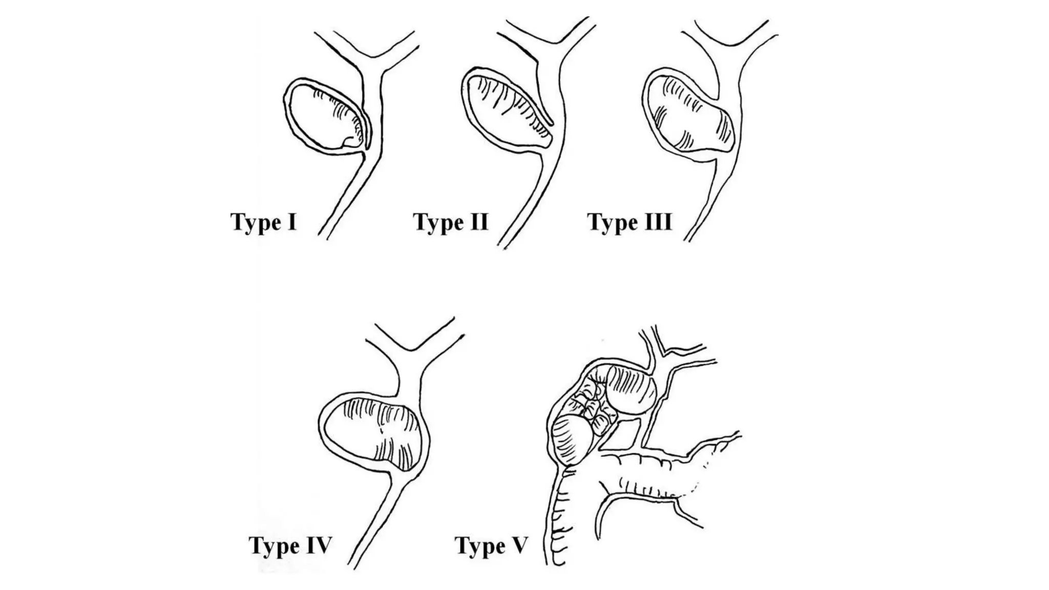 Mirizzi , Bouveret syndrome.pptx