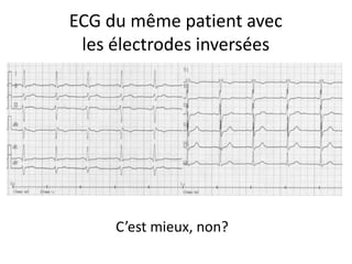 ECG du même patient avec
 les électrodes inversées




     C’est mieux, non?
 