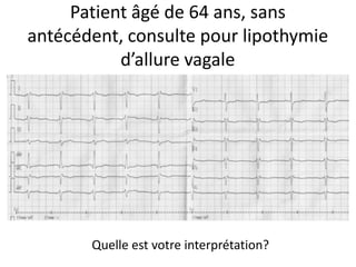 Patient âgé de 64 ans, sans
antécédent, consulte pour lipothymie
           d’allure vagale




       Quelle est votre interprétation?
 