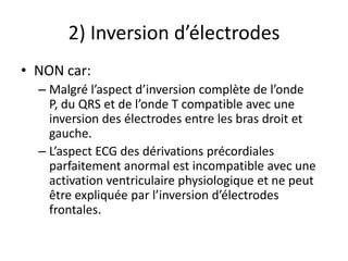 2) Inversion d’électrodes
• NON car:
  – Malgré l’aspect d’inversion complète de l’onde
    P, du QRS et de l’onde T compatible avec une
    inversion des électrodes entre les bras droit et
    gauche.
  – L’aspect ECG des dérivations précordiales
    parfaitement anormal est incompatible avec une
    activation ventriculaire physiologique et ne peut
    être expliquée par l’inversion d’électrodes
    frontales.
 