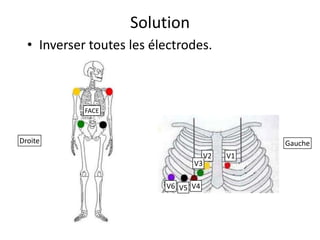 Solution
  • Inverser toutes les électrodes.



            FACE



Droite                                         Gauche
                                     V2   V1
                                V3

                          V6 V5 V4
 