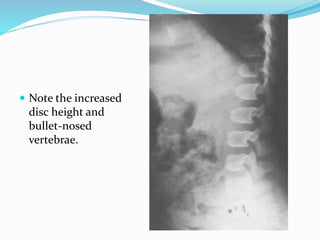  Note the increased
disc height and
bullet-nosed
vertebrae.
 