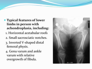 Typical features of lower
limbs in person with
achondroplasia, including:
1. Horizontal acetabular roofs
2. Small sacrosciatic notches.
3. Inverted V-shaped distal
femoral physis.
4. Genu varum and ankle
varum with relative
overgrowth of fibula.
 