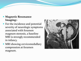 Magnetic Resonance
Imaging:-
 For the incidence and potential
severity of neurologic symptoms
associated with foramen
magnum stenosis, a baseline
MRI is strongly recommended
in infancy.
 MRI showing cervicomedullary
compression at foramen
magnum.
 
