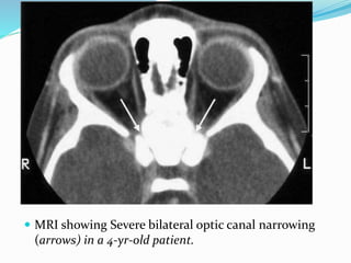  MRI showing Severe bilateral optic canal narrowing
(arrows) in a 4-yr-old patient.
 