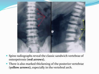  Spine radiographs reveal the classic sandwich vertebrae of
osteopetrosis (red arrows).
 There is also marked thickening of the posterior vertebrae
(yellow arrows), especially in the vertebral arch.
 