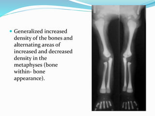  Generalized increased
density of the bones and
alternating areas of
increased and decreased
density in the
metaphyses (bone
within- bone
appearance).
 