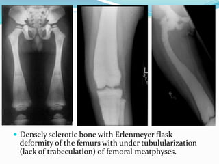  Densely sclerotic bone with Erlenmeyer flask
deformity of the femurs with under tubulularization
(lack of trabeculation) of femoral meatphyses.
 