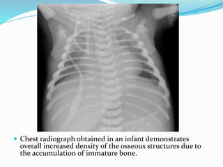  Chest radiograph obtained in an infant demonstrates
overall increased density of the osseous structures due to
the accumulation of immature bone.
 