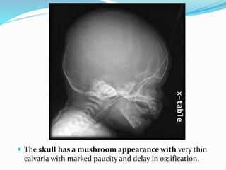  The skull has a mushroom appearance with very thin
calvaria with marked paucity and delay in ossification.
 