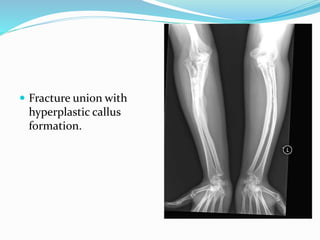  Fracture union with
hyperplastic callus
formation.
 